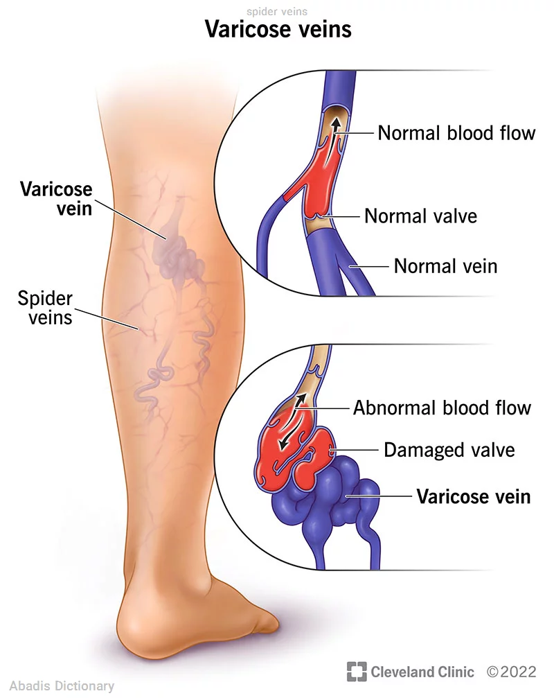 spider veins